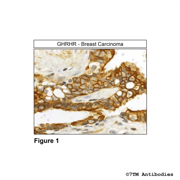 Immunohistochemical identification of Growth Hormone-Releasing Hormone Receptor in breast carcinoma.