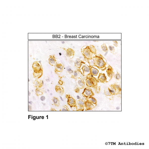 Immunohistochemical identification of Bombesin Receptor 2/Gastrin-Relasing Peptide Receptor (BB2/GRPR) in human breast carcinoma.