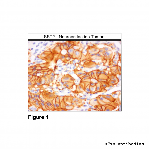 Immunohistochemical identification of Somatostatin Receptor 2 in human neuroendocrine tumor tissue.