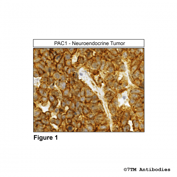 Immunohistochemical identification of PACAP Receptor 1 in human neuroendocrine tumor