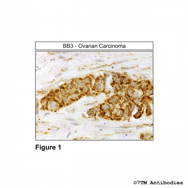 Immunohistochemical identification of Bombesin receptor 3 in human ovarian carcinoma.