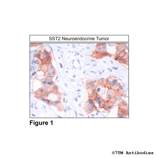 Immunohistochemical identification of Somatostatin Receptor 2 in human neuroendocrine tumor tissue