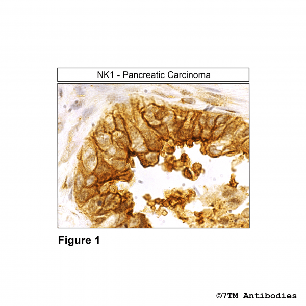 Immunohistochemical identification of Tachykinin Receptor 1 in pancreatic carcinoma