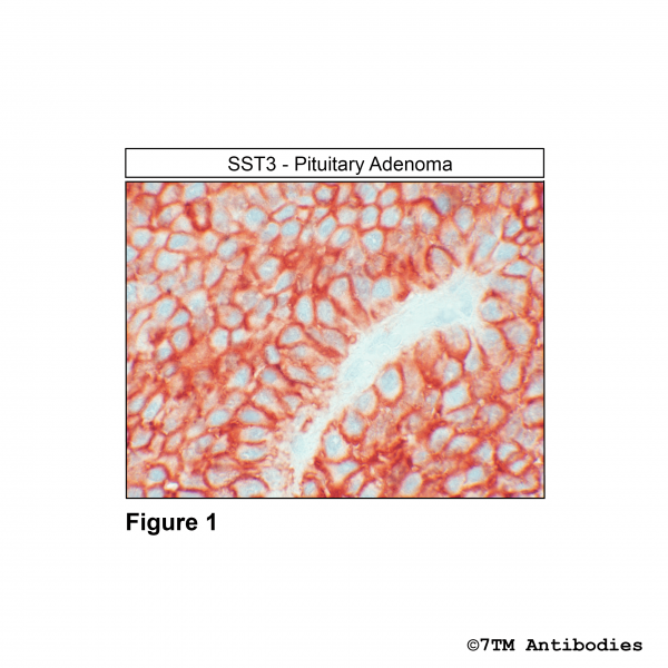Immunohistochemical identification of Somatostatin Receptor 3 in human growth-hormone-producing pituitary adenoma tissue.