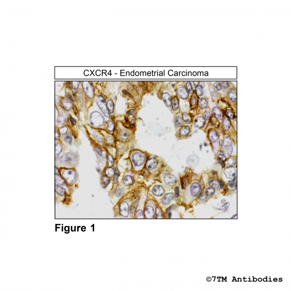 Immunohistochemical identification of CXC Chemokine Receptor 4 in human endometrial carcinoma.